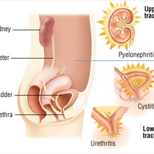 Urinary Tract Infections Home Remedies - Home Remedies For Urinary Tract Infection: Do Cranberry Products Work?
