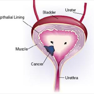 Bladder Infections - Treat Urinary Tract Infection By Non-Antibiotic Methods