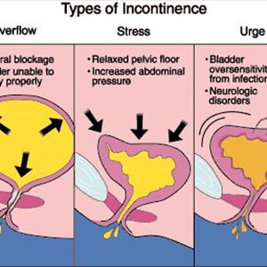 Alternative Treatments For Chronic Uti Photos - What Is A Urinary Tract Infection